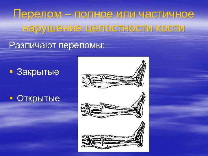Перелом – полное или частичное нарушение целостности кости Различают переломы: § Закрытые § Открытые
