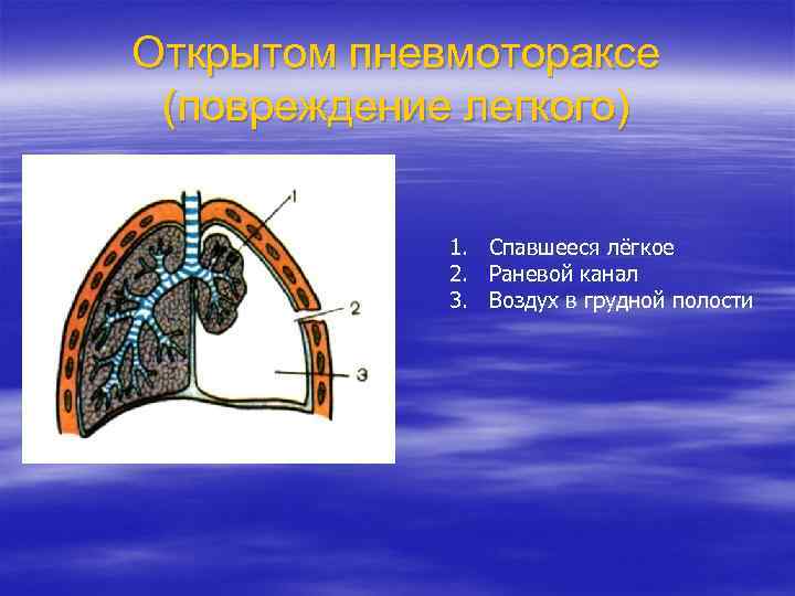 Открытом пневмотораксе (повреждение легкого) 1. Спавшееся лёгкое 2. Раневой канал 3. Воздух в грудной