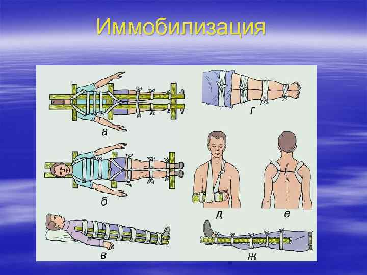 Иммобилизация 