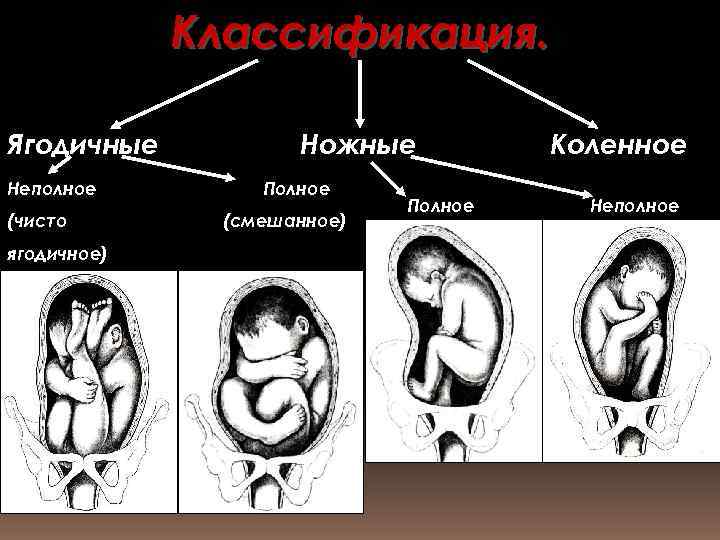 Классификация. Ягодичные Неполное (чисто ягодичное) Ножные Полное (смешанное) Полное Коленное Неполное 