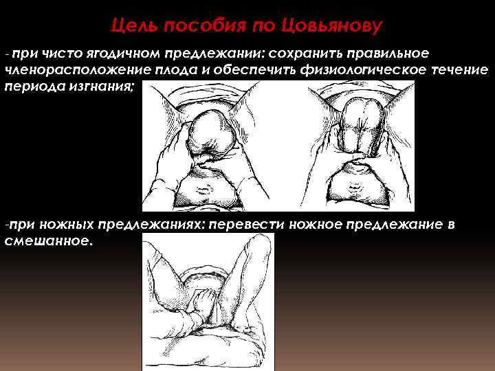 Цель пособия по Цовьянову - при чисто ягодичном предлежании: сохранить правильное членорасположение плода и
