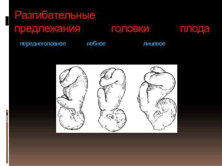 Разгибательные предлежания переднеголовное лобное головки лицевое плода 