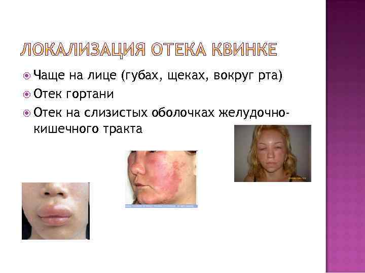  Чаще на лице (губах, щеках, вокруг рта) Отек гортани Отек на слизистых оболочках