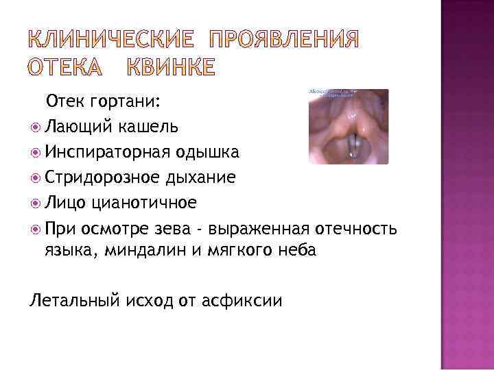 Отек гортани: Лающий кашель Инспираторная одышка Стридорозное дыхание Лицо цианотичное При осмотре зева -