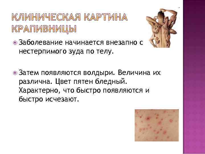  Заболевание начинается внезапно с нестерпимого зуда по телу. Затем появляются волдыри. Величина их
