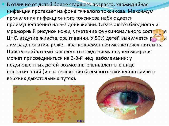  В отличие от детей более старшего возраста, хламидийная инфекция протекает на фоне тяжелого