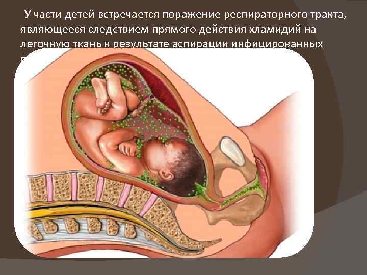  У части детей встречается поражение респираторного тракта, являющееся следствием прямого действия хламидий на