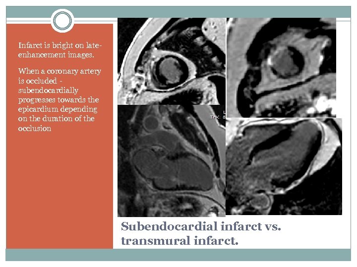 Infarct is bright on lateenhancement images. When a coronary artery is occluded - subendocardially