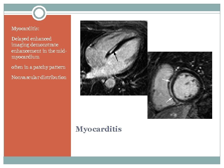 Myocarditis: Delayed enhanced imaging demonstrate enhancement in the midmyocardium often in a patchy pattern