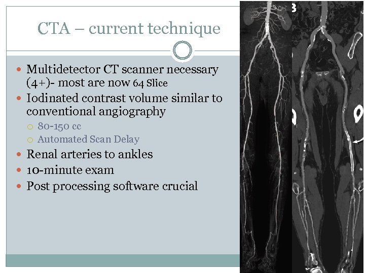 CTA – current technique Multidetector CT scanner necessary (4+)- most are now 64 Slice