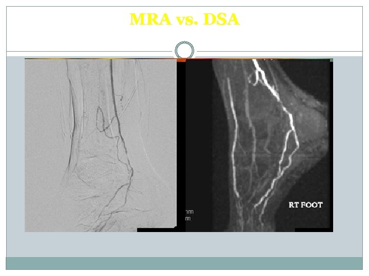 MRA vs. DSA 