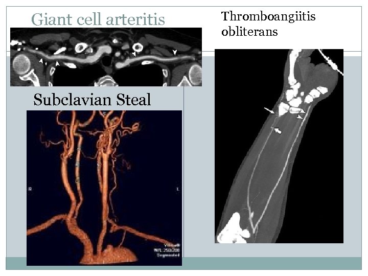 Giant cell arteritis Subclavian Steal Thromboangiitis obliterans 