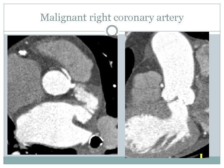 Malignant right coronary artery 