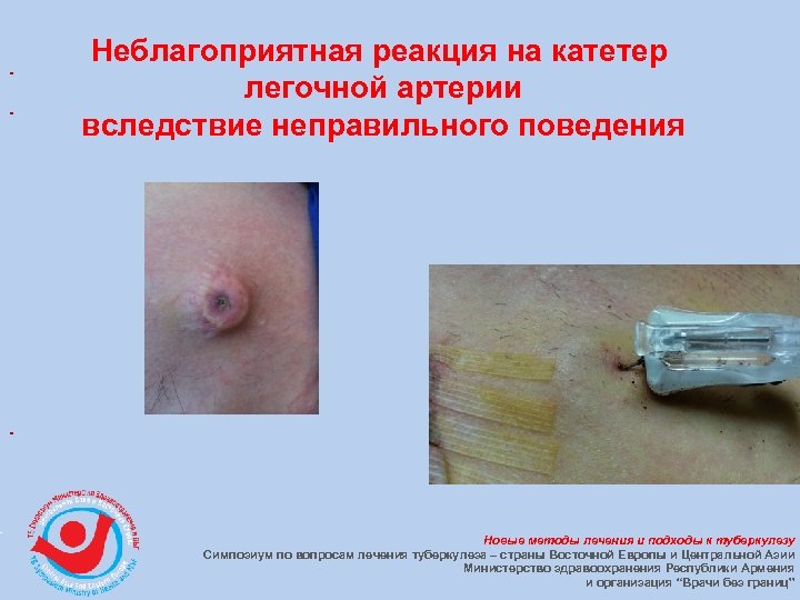 Неблагоприятная реакция на катетер легочной артерии вследствие неправильного поведения Новые методы лечения и подходы