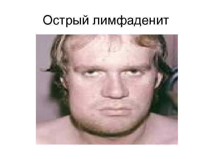 Острый лимфаденит 