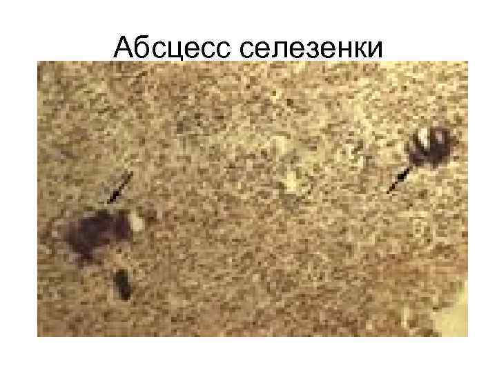 Абсцесс селезенки 