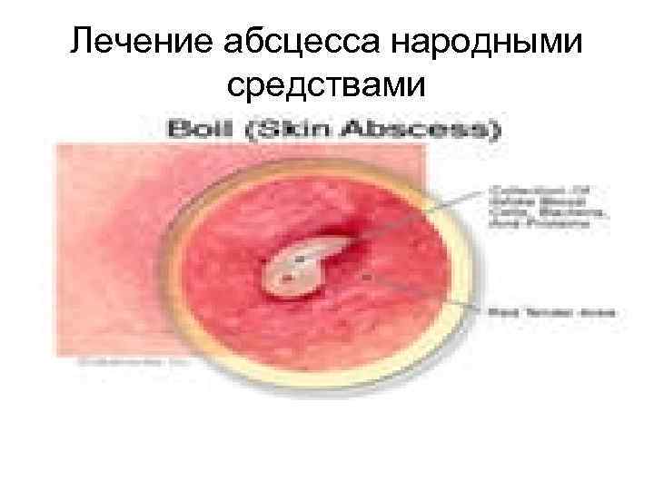 Лечение абсцесса народными средствами 