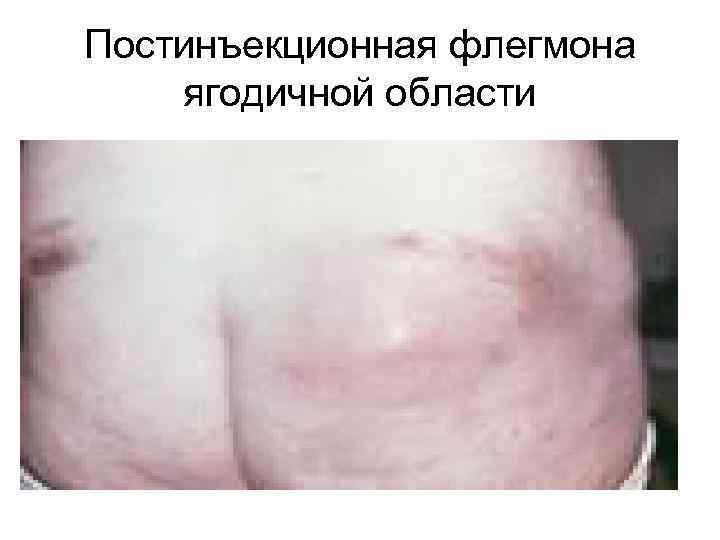 Постинъекционная флегмона ягодичной области 