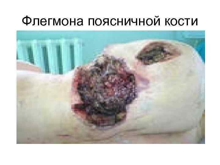 Флегмона поясничной кости 