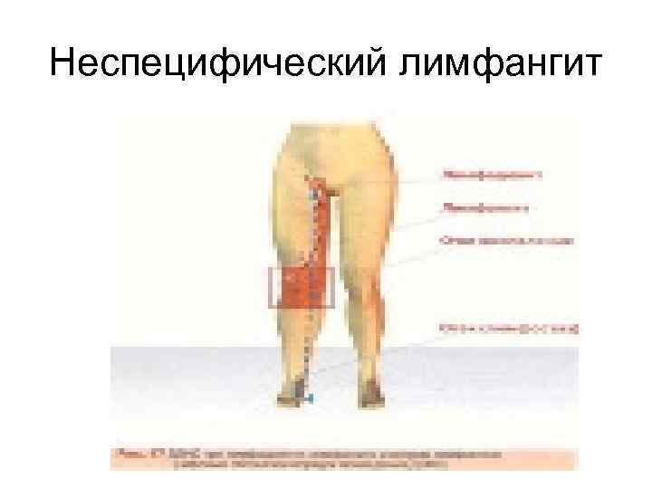 Неспецифический лимфангит 