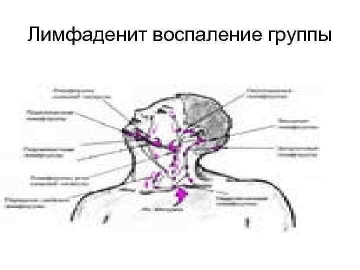 Надключичные лимфоузлы где. Лимфаденит надключичные лимфоузлы. Правосторонний поднижнечелюстной лимфаденит. Атлас Леднева лимфаденит. Лимфаденит шейный правосторонний.