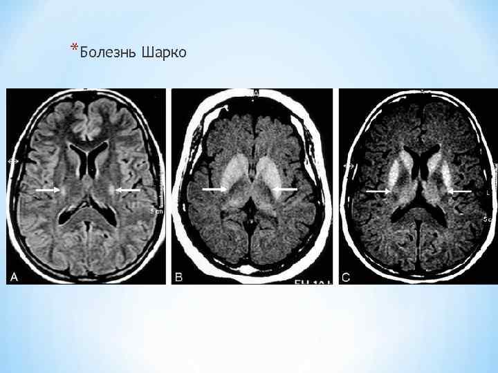 *Болезнь Шарко 
