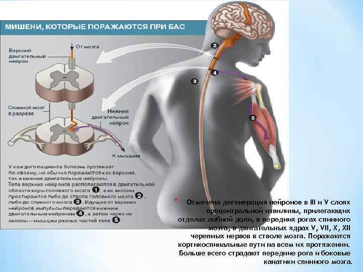 * Отмечена дегенерация нейронов в III и V слоях прецентральной извилины, прилегающих отделах лобной