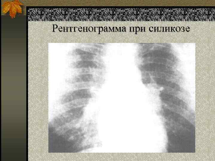 Рентгенограмма при силикозе 