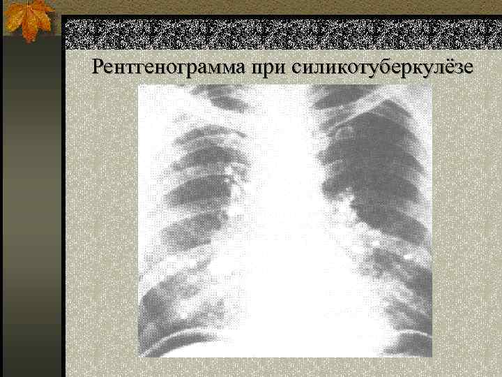 Рентгенограмма при силикотуберкулёзе 