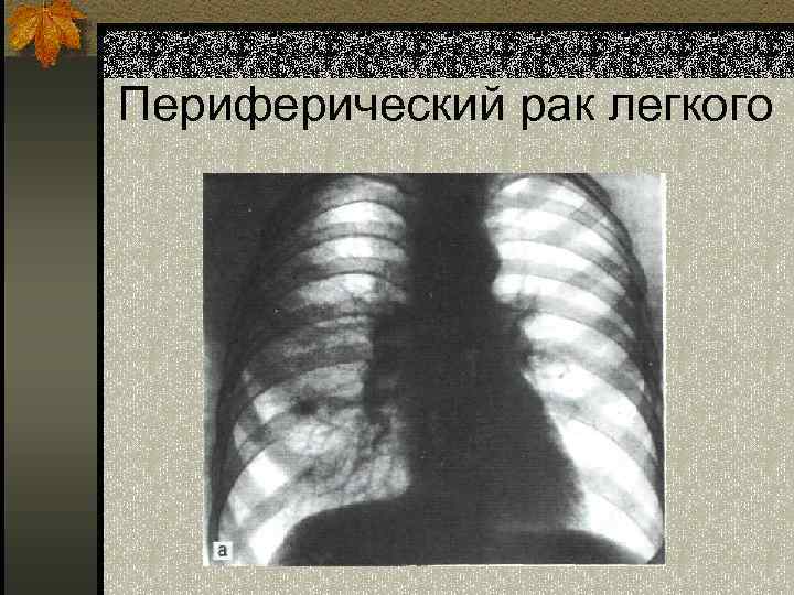 Периферический рак легкого 