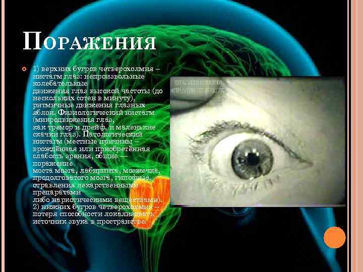 ПОРАЖЕНИЯ 1) верхних бугров четверохолмия – нистагм глаз: непроизвольные колебательные движения глаз высокой частоты