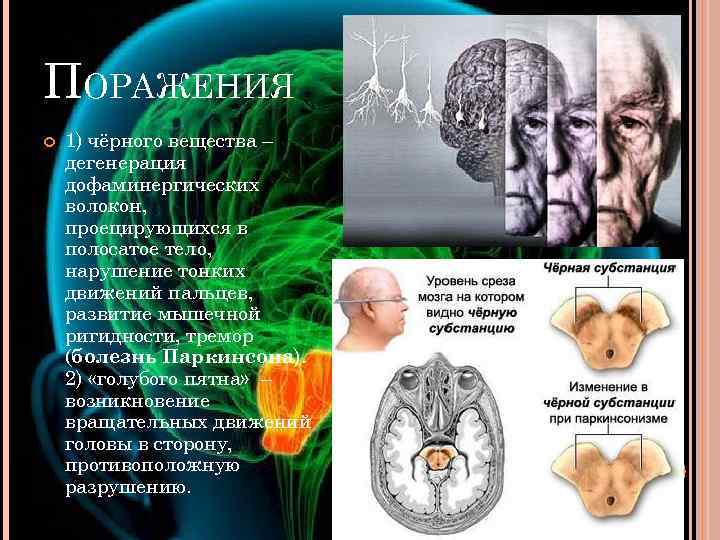 ПОРАЖЕНИЯ 1) чёрного вещества – дегенерация дофаминергических волокон, проецирующихся в полосатое тело, нарушение тонких
