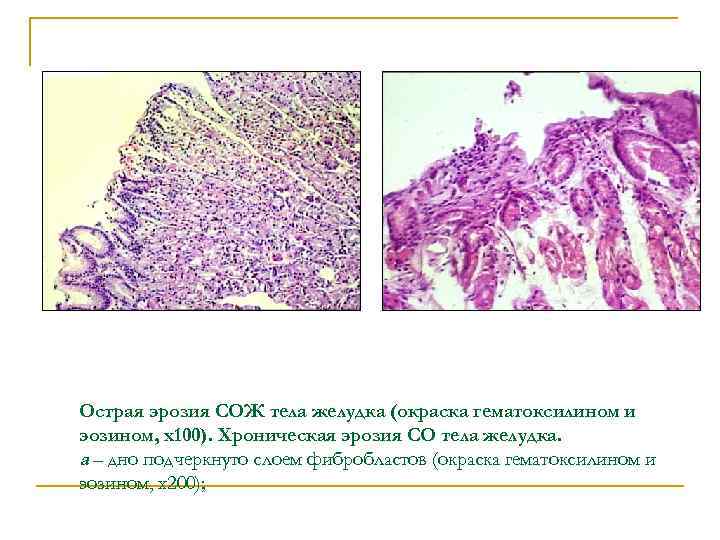 Острая эрозия СОЖ тела желудка (окраска гематоксилином и эозином, х100). Хроническая эрозия СО тела