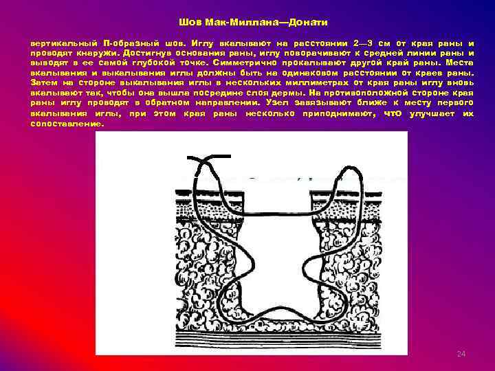 Шов Мак-Миллана—Донати вертикальный П-образный шов. Иглу вкалывают на расстоянии 2— 3 см от края