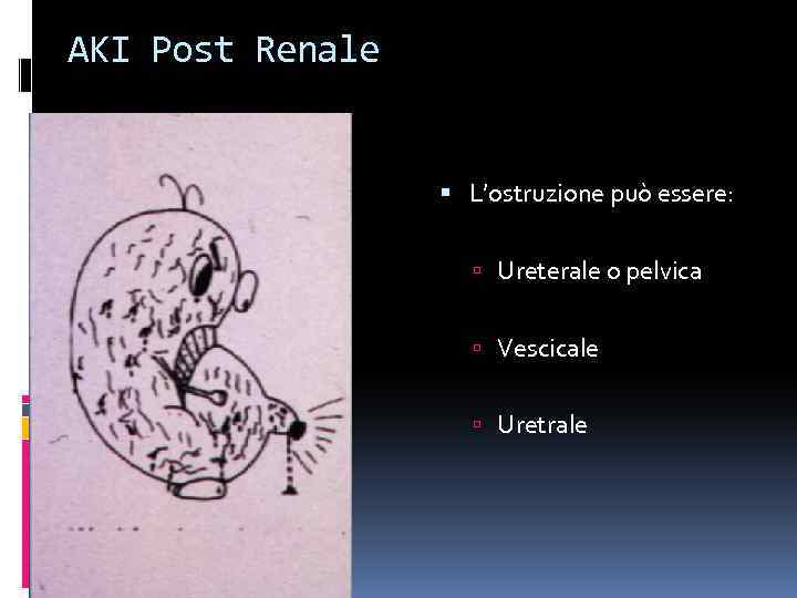 AKI Post Renale L’ostruzione può essere: Ureterale o pelvica Vescicale Uretrale 