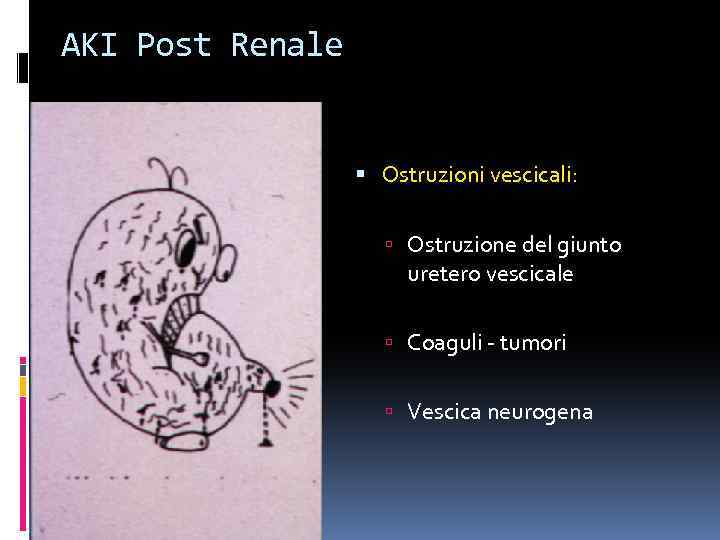 AKI Post Renale Ostruzioni vescicali: Ostruzione del giunto uretero vescicale Coaguli - tumori Vescica