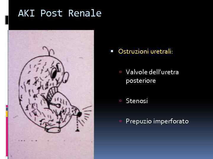 AKI Post Renale Ostruzioni uretrali: Valvole dell’uretra posteriore Stenosi Prepuzio imperforato 