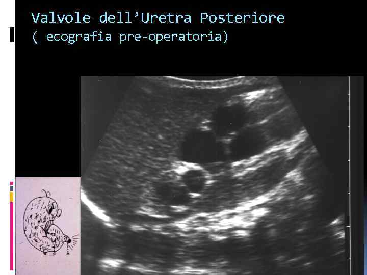 Valvole dell’Uretra Posteriore ( ecografia pre-operatoria) 