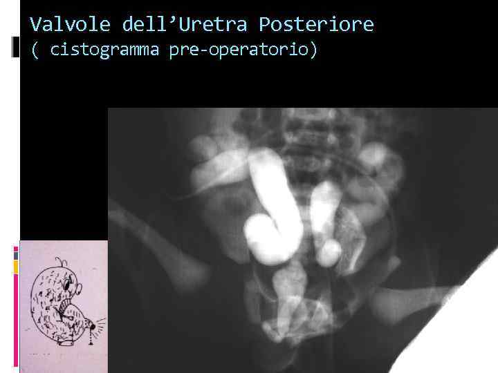 Valvole dell’Uretra Posteriore ( cistogramma pre-operatorio) 