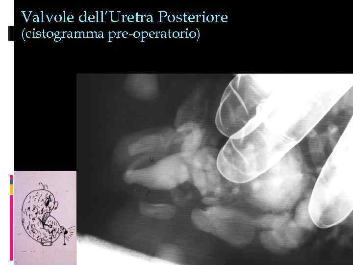 Valvole dell’Uretra Posteriore (cistogramma pre-operatorio) 