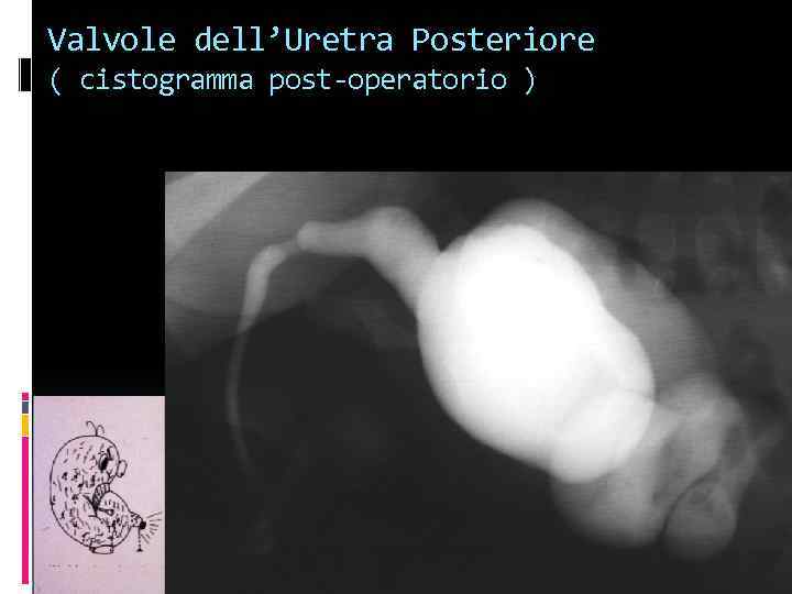 Valvole dell’Uretra Posteriore ( cistogramma post-operatorio ) 