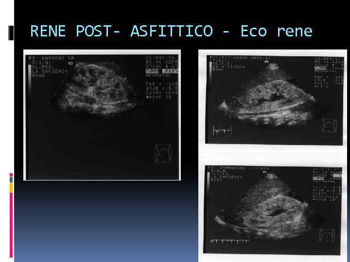 RENE POST- ASFITTICO - Eco rene 