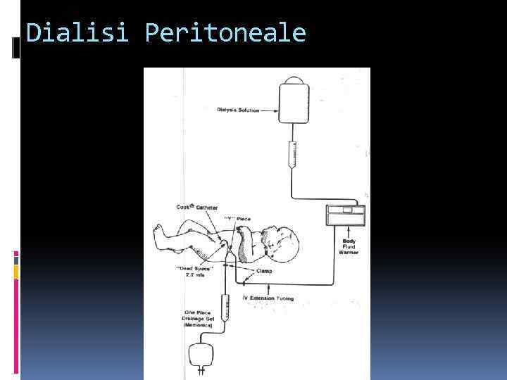 Dialisi Peritoneale 