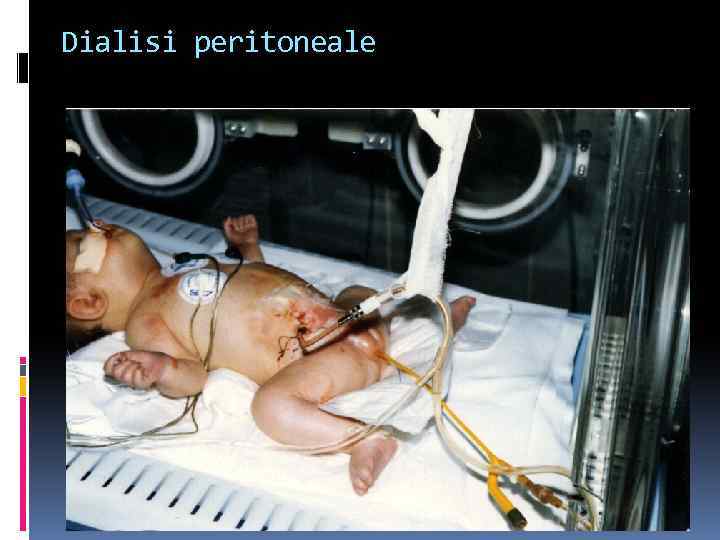 Dialisi peritoneale 