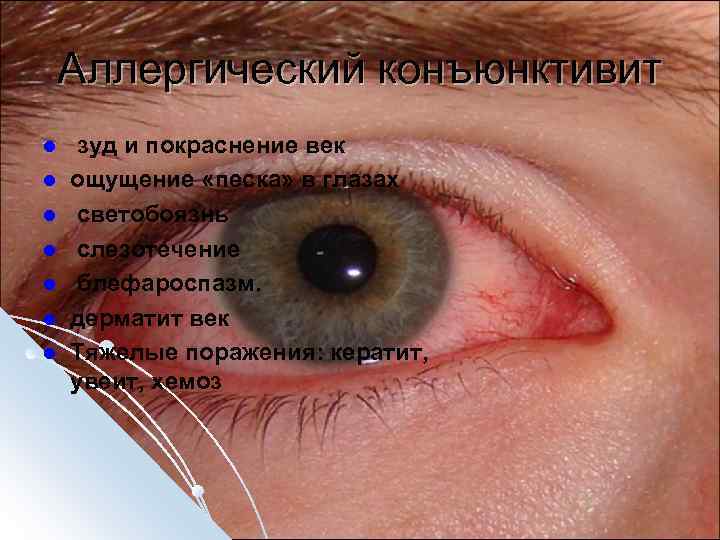 Аллергический конъюнктивит l l l l зуд и покраснение век ощущение «песка» в глазах
