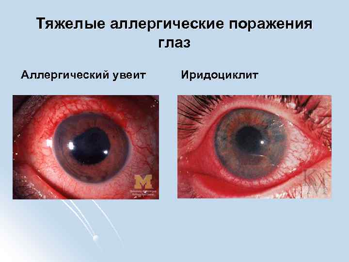 Тяжелые аллергические поражения глаз Аллергический увеит Иридоциклит 