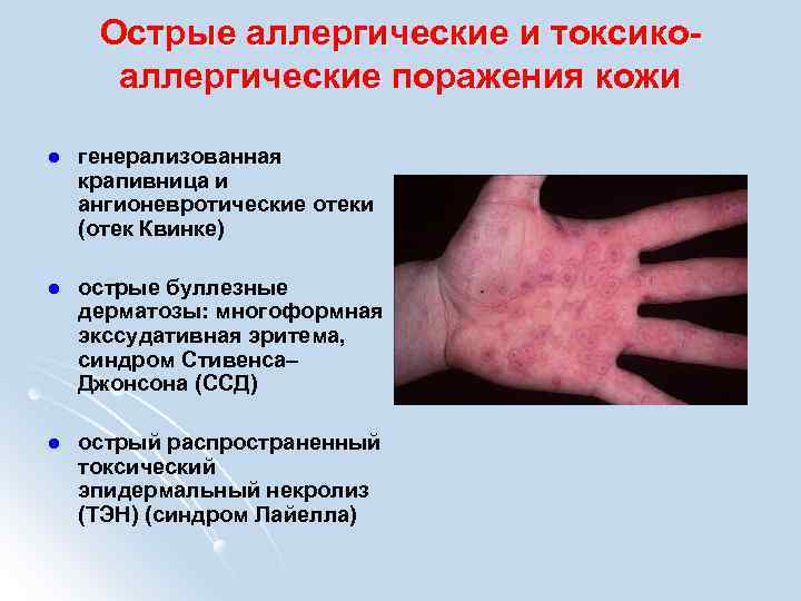 Острые аллергические и токсикоаллергические поражения кожи l генерализованная крапивница и ангионевротические отеки (отек Квинке)