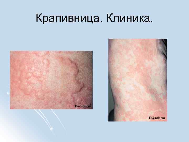Крапивница. Клиника. 