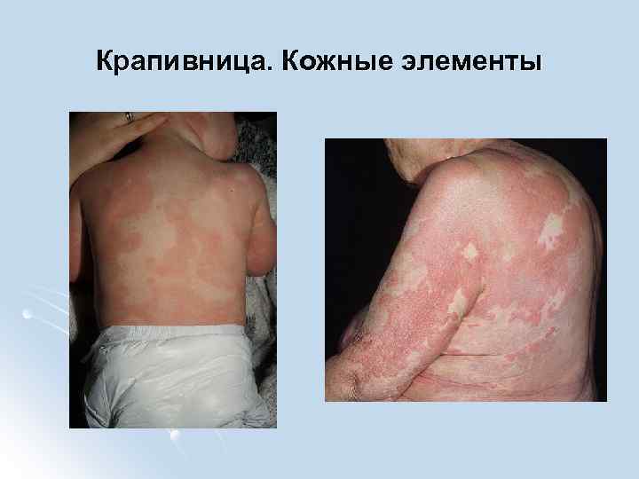 Крапивница. Кожные элементы 