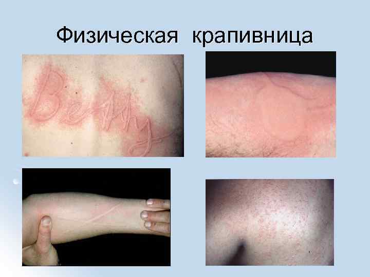 Физическая крапивница 